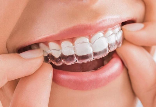 Invisalign là một phương pháp niềng răng hô hiện đại và không gây sự không thoải mái