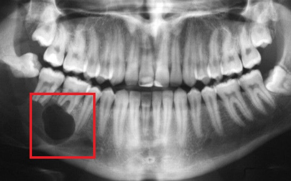 Phẫu thuật nang chân răng bao lâu thì khỏi?