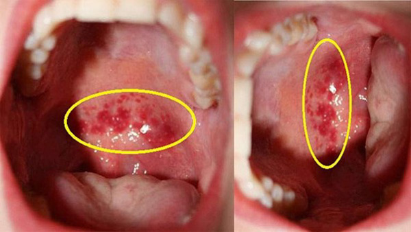 Viêm họng hạt do virus làm cho sưng to và đỏ đậm