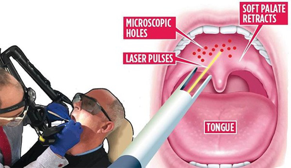 Điều trị viêm họng hạt bằng phương pháp đốt hạt