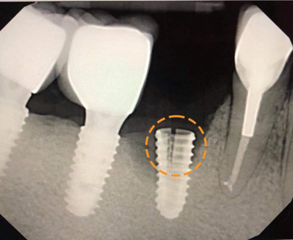 Trụ implant bị gãy, nứt