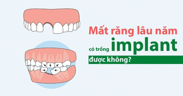 Mất răng lâu năm giờ trồng răng implant cần phải xem xét chi tiết tình trạng răng