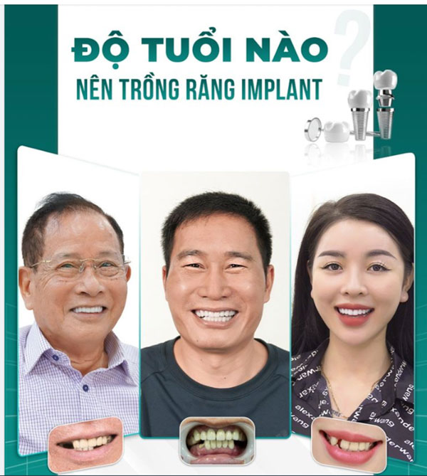 Khuyến khích những người trưởng thành chọn lựa phương pháp trồng răng implant