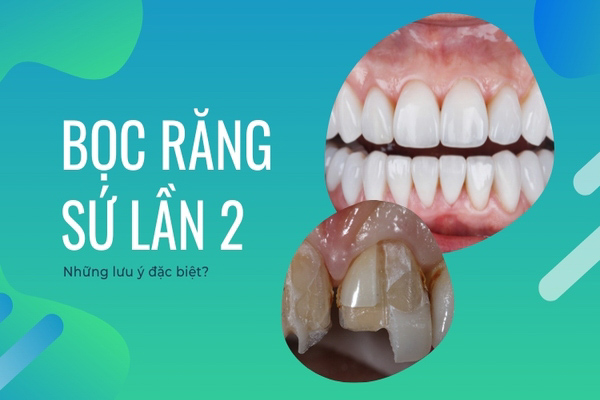 Bọc răng sứ lần 2 có được không? Quy trình thực hiện như thế nào? 6