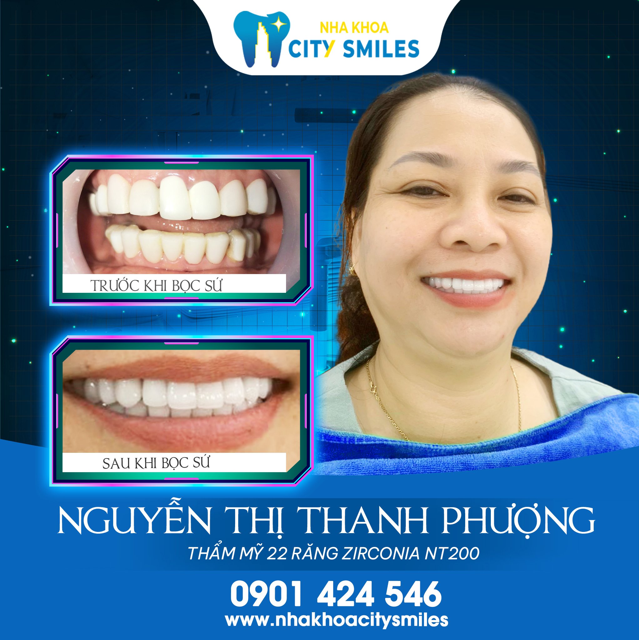 Chị Phương - Thẩm mỹ bọc 22 răng sứ Zirconia NT200