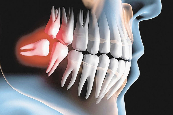 Răng mọc ngầm có gây nguy hiểm không?