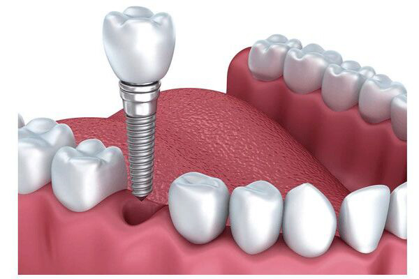 Trụ răng implant là gì?