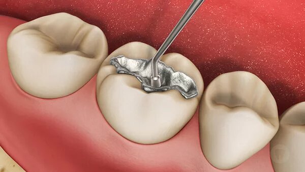 Các trường hợp phải trám răng