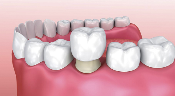 Bọc răng sứ là một giải pháp đa chiều giúp khắc phục nhiều vấn đề về nướu và răng