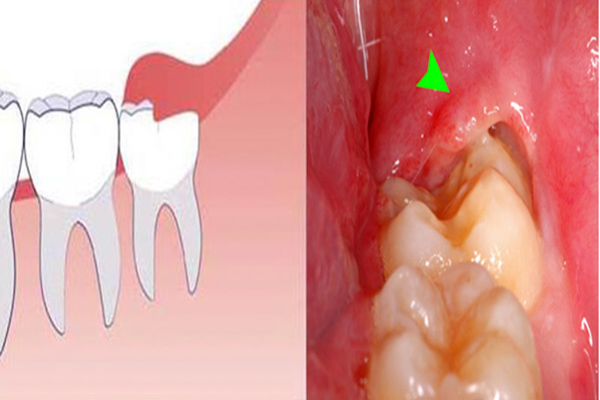 Triệu chứng đau răng khôn là gì?