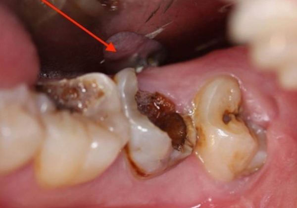 Nếu không được điều trị kịp thời và đúng cách, viêm tủy răng sẽ gây biến chứng nguy hiểm