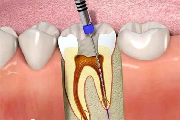 Trong quá trình điều trị sưng chân răng, hai phương pháp chính mà nha sĩ có thể áp dụng là lấy tủy răng và nhổ răng