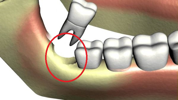 Lỗ sau khi nhổ răng khôn là một khoảng trống trong nướu