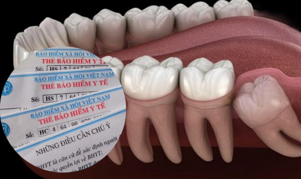 Nhổ răng khôn có được bảo hiểm không? Giải đáp chi tiết