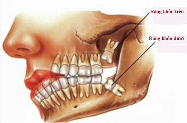 Răng khôn còn được biết đến là răng số 8