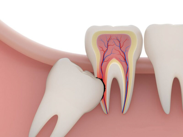 Răng khôn mọc lệch có thể làm các răng khác chen chúc