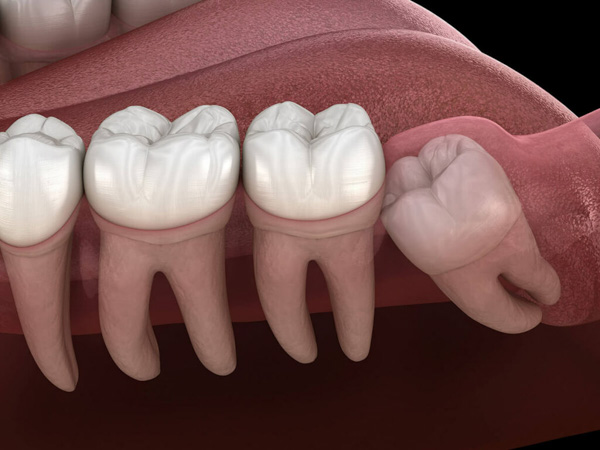 Răng khôn mọc lệch 45 độ có nguy hiểm không?