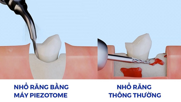 Các biện pháp nhổ răng khôn mọc lệch 45 độ an toàn