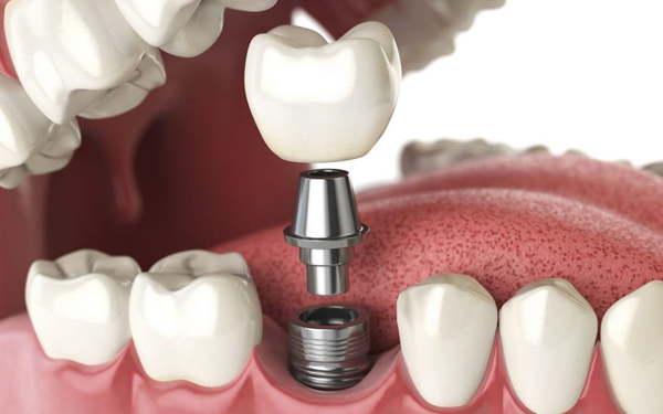 Trồng răng cố định bằng việc cấy ghép implant hiện đại