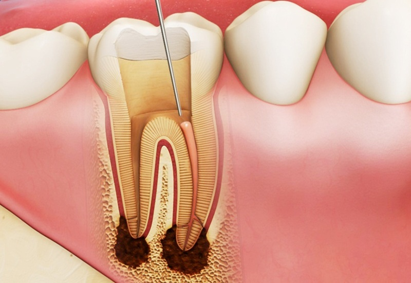 Nếu sâu răng tiến sâu đến tủy răng, có thể gây ra viêm nhiễm và đau đớn