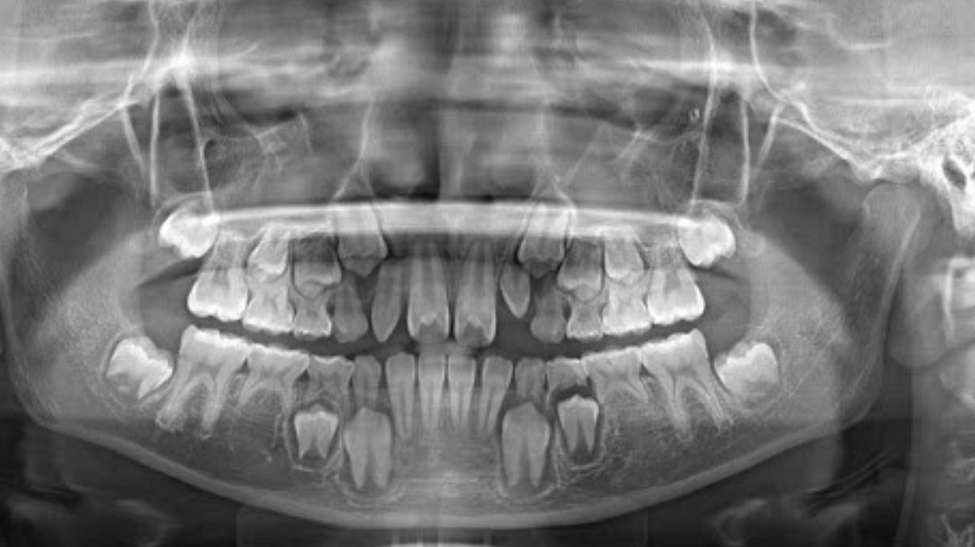 Răng vĩnh viễn không mọc lên sẽ ảnh hưởng đến sức khỏe răng miệng