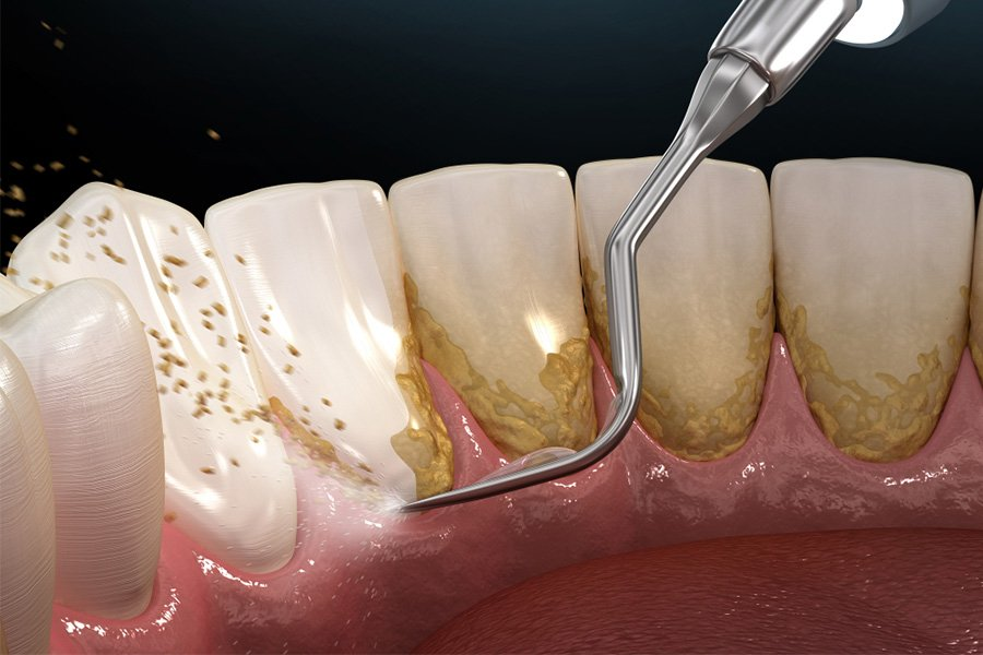 Bác sĩ lấy vôi răng và làm sạch sâu gốc răng