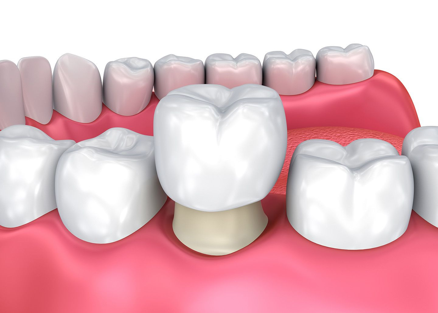 Mài răng để bọc răng sứ thẩm mỹ là một quy trình nha khoa quan trọng giúp cải thiện vẻ đẹp tự nhiên