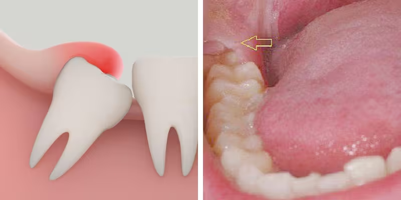 Răng khôn là một phần quan trọng của quá trình phát triển răng của con người