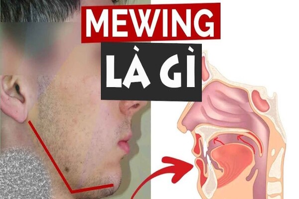 Mewing là gì?