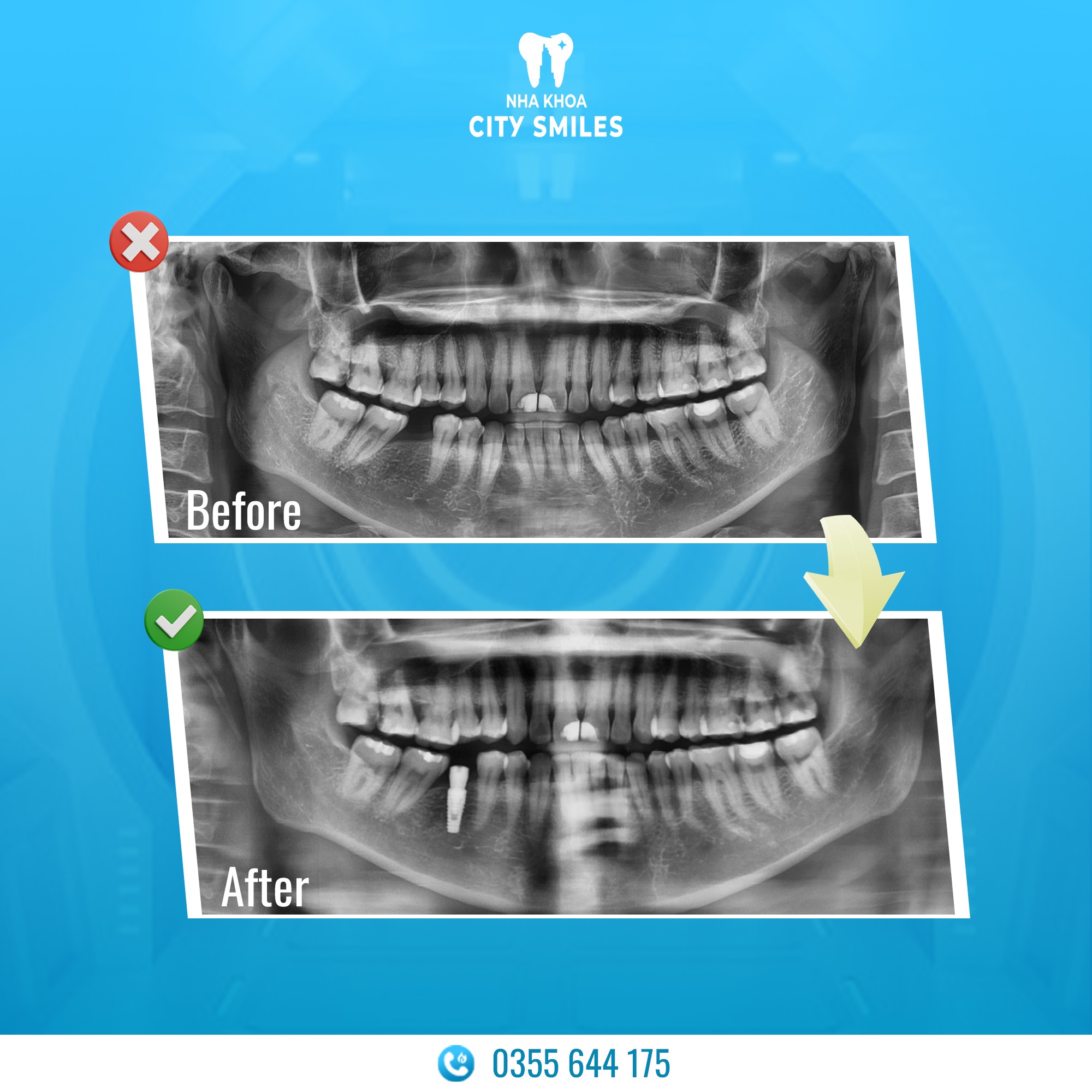 Trồng răng Implant