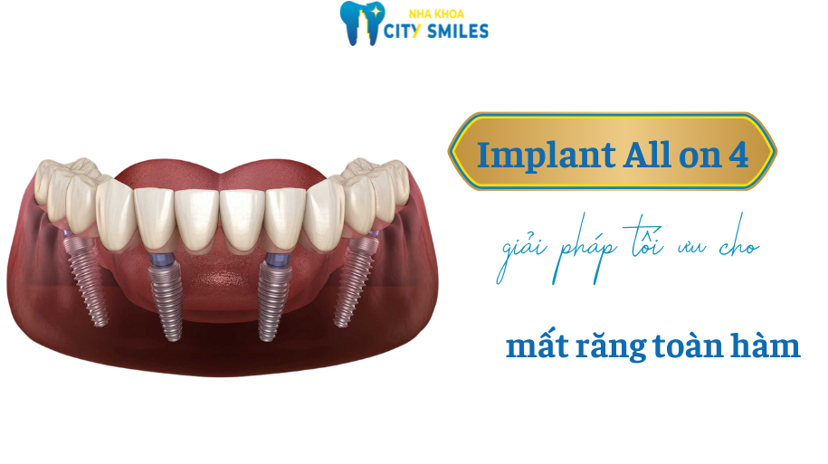 trồng răng Implant All on 4