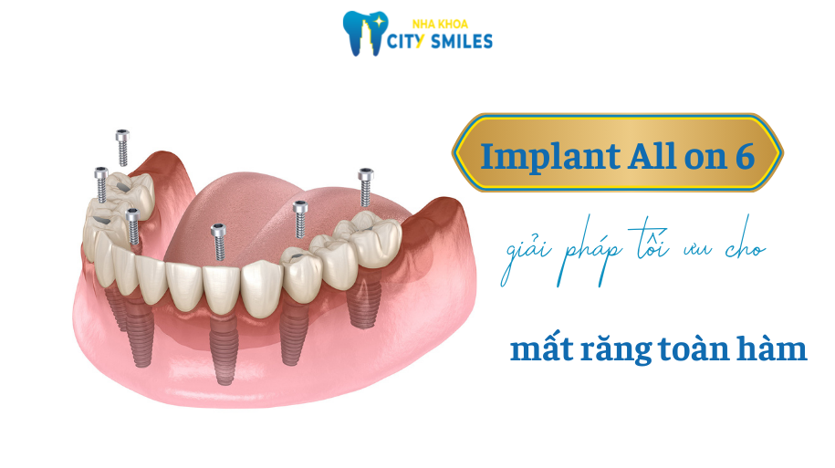 trồng răng Implant all on 6