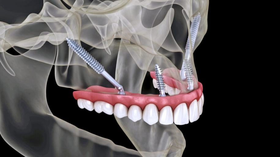 cấy ghép Implant xương gò má