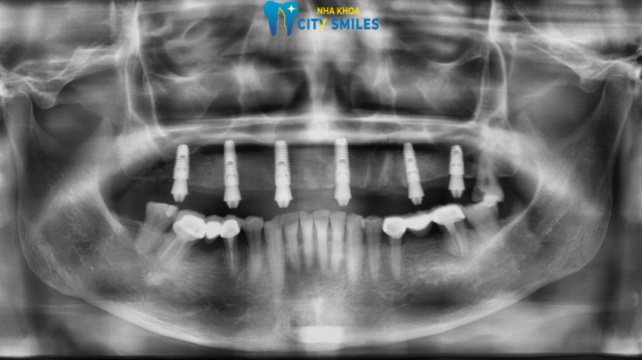 trồng răng Implant toàn hàm