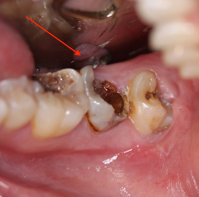 Các triệu chứng khi chân răng bị sâu