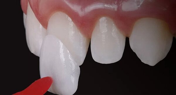 Dán sứ veneers