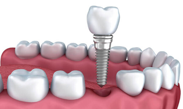 Bọc sứ implant