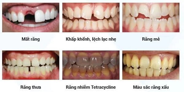 Các trường hợp nên bọc răng sứ