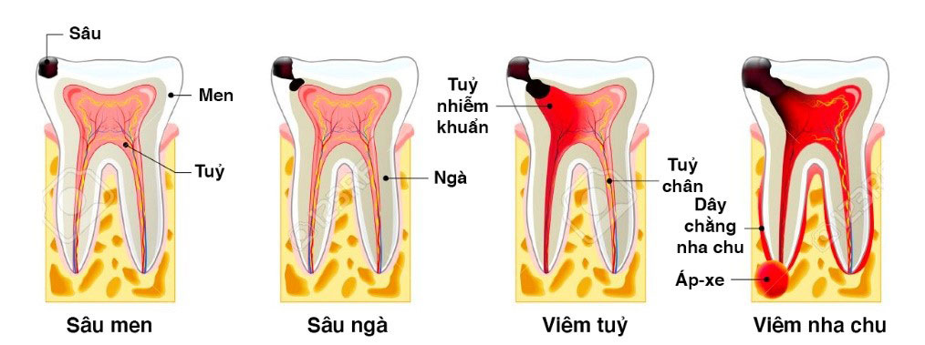 Các giai đoạn phát triển của bệnh sâu răng