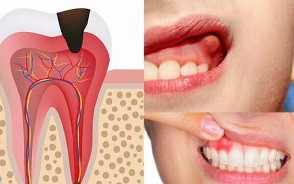 Cắt nạo chóp răng không gây đau đớn