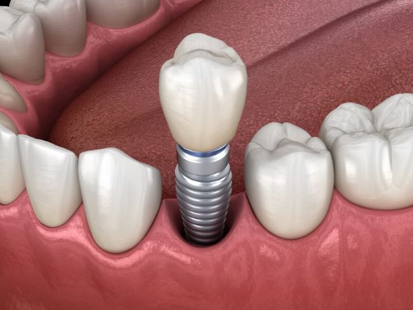 Trồng răng Implant là phương pháp cấy ghép implant vào xương hàm