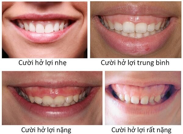 Có 4 mức độ cười hở lợi thường gặp