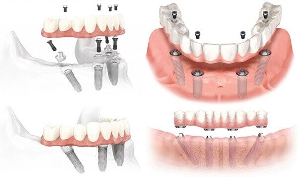 Hàm giả tháo lắp làm từ trụ implant