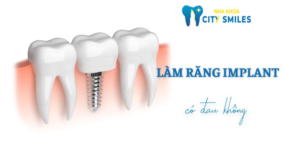 làm Implant có đau không