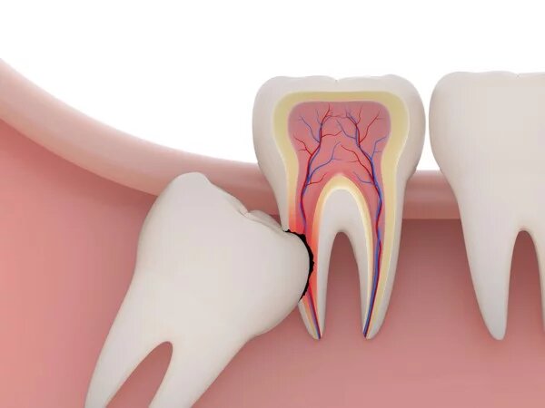 Mọc răng khôn gây sưng lợi và đau nhức quanh lợi