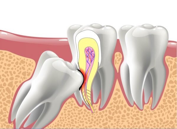 Cần nhổ răng khôn nếu chúng gây nên tình trạng đau nhức