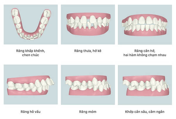 Nên thực hiện niềng răng khi gặp các khuyết điểm về răng