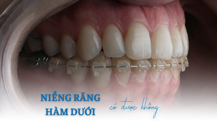 niềng răng hàm dưới