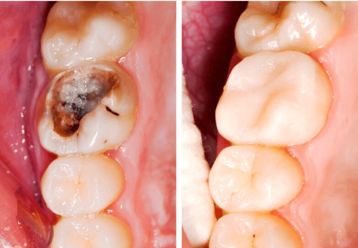 Trám răng là phương pháp điều trị phổ biến nhất đối với sâu răng