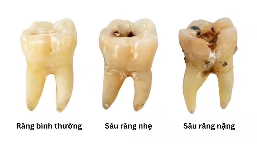 Các mức độ của tình trạng sâu răng có lỗ thủng